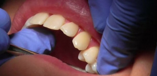 Mokslininkai sugalvojo visiškai beskausmį dantų taisymo būdą – bus galima pamiršti grąžtus ir plombas